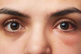 midtown optometry 3 types of pink eye
