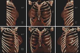 The ribs are a set of twelve paired bones which form the protective 'cage' of the thorax. 3d Surface Shaded Display From Thoracic Ct Data After The Positioning Download Scientific Diagram