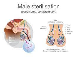 What is a Vasectomy?