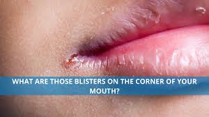 blisters on the corner of your mouth