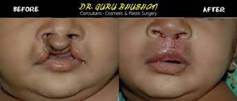 cleft lip cleft palate dr