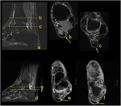 1 department of radiology and inje university busan paik hospital, inje university college of haglund syndrome was first described in 1928 as retrocalcaneal bursitis associated with an. Mri Of The Achilles Tendon A Comprehensive Pictorial Review Part Two European Journal Of Radiology Open