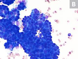 Secondary septic peritonitis is commonly associated with perforation of and leakage from gi organs (eg, traumatic reticuloperitonitis in cattle), with subsequent. Effusion Cytology Clinician S Brief
