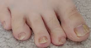 toenail fungus infections