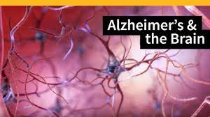 the brain in alzheimer s disease