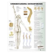 Understanding Osteoporosis Chart Poster Laminated