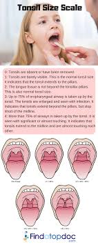 What Is Tonsil Grading Symptoms Size And System