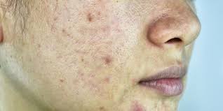 acne redness treatments causes