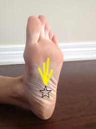 plantar fasciitis physical therapy in
