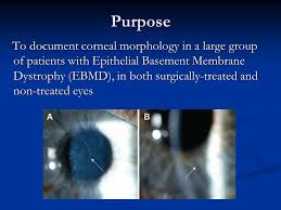 American academy of opthamology eyewiki. Corneal Morphology In Epithelial Basement Membrane Dystrophy A Large Cross Sectional Study With In Vivo Confocal Microscopy Johan Germundsson M D Per Ppt Download