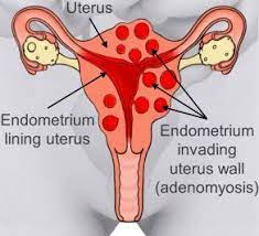 In minimal endometriosis, there is a presence of few small wounds, lesions or implants over the ovary without any scar tissue. Adenomyosis Jean Hailes