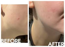deep relief acne treatment