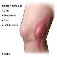 flebitis care guide information en espanol