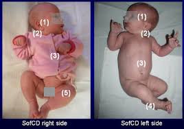 It may be from a blockage of blood flow to the chest, shoulder, arm, and hand muscles while a baby is developing in the womb. Syndrome Of Contractures And Deformities According Prof Hans Mau Symptoms Diagnosis Treatment Recommendations For Parents