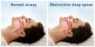 Obstructive sleep disorders apnea - Sleep Disorders - Sleep Apnea