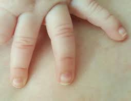 white lines on fingernails babycenter