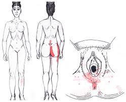 myofascial pain syndrome in women