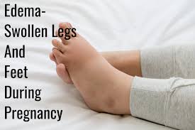 edema swollen legs and feet during