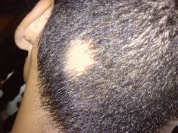 Follicles are densest on your scalp, and they occur everywhere on your body except your palms, soles, lips and mucous membranes. Alopecia Areata Wikipedia