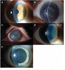 Anterior basement membrane corneal dystrophy. Figure 2 From Pediatric Genetic Disease Of The Cornea Semantic Scholar