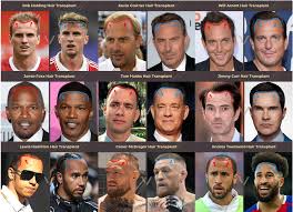 celebrities with hair transplants 40