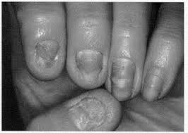 treatment of common nail disorders