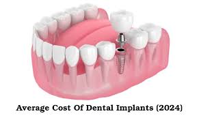 average cost of one dental implant