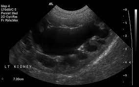 sagittal ultrasound image of the left