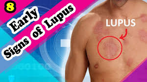 7 signs and symptoms of lupus you