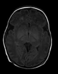 Maybe you would like to learn more about one of these? Periventricular Leukomalacia Mri Sumer S Radiology Blog