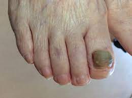 足の親指の爪が黒い｜肥厚爪ケアの事例32 | ドクターネイル爪革命®