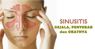 sinusitis