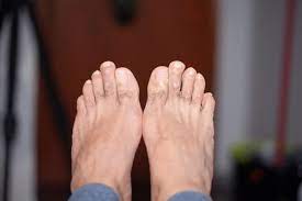 how to get rid of calluses causes and