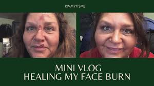 mini vlog healing my face rug burn