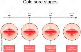 cold sore ses lips with symptoms of
