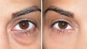 dark circles under eye bags