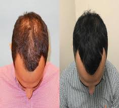 affordable prp hair loss treatment in