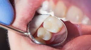 Learn how to tell if you have cavities and what you can do about it. Reasons Behind Cavity Susceptibility After Having Braces