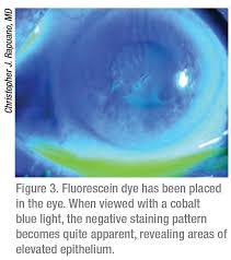 This article covers the following corneal disorders: When And How To Treat Ebmd