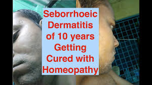 seborrhoeic dermais from 10 years