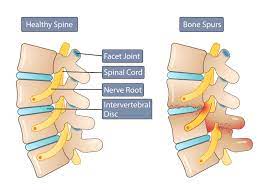 bone spurs symptoms causes what is