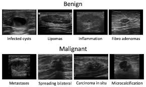 Some breast changes can be felt by a woman or her health care provider, but most can be detected only during an imaging procedure such as a mammogram, mri, or ultrasound. Automating Breast Cancer Detection With Deep Learning By Sheng Weng Insight