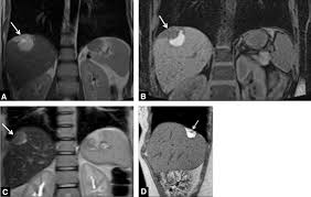 14 had surgical confirmation and nine had symptoms relief with hormonal treatment. Mr Imaging Of Endometriosis Spectrum Of Disease Sciencedirect