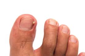 painful ingrown toenail treatment singapore