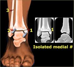 When people are involved in car accidents, the collision can sometimes be more serious than a simple fender bender.when a motorist turns the wheel sharply to avoid an object in the road in front of them, the car will often flip. The Radiology Assistant Special Cases Of Ankle Fractures