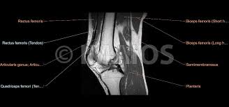 Mri for evaluating knee pain in older patients: The Knee Mri Atlas Of Anatomy In Medical Imagery