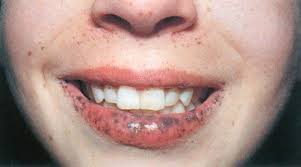 black spots on lips causes and how to
