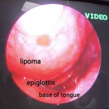 pharyngeal lipoma a potentially life
