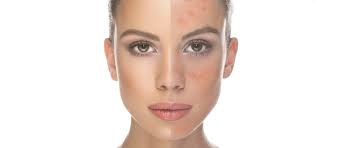 Image result for acne and stem cell therapy