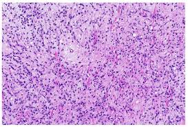 myxoid liposarcoma showing diffe